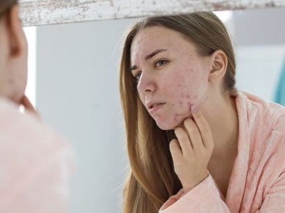 How to use witch hazel for adult acne
